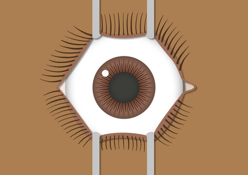 Eye surgery, illustration