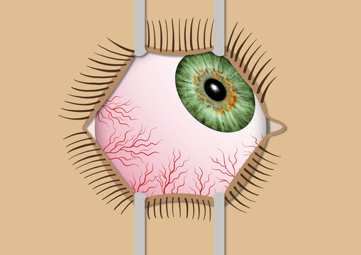 Eye surgery, illustration