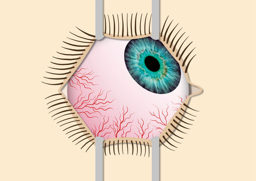 Eye surgery, illustration