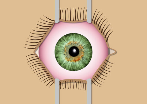 Eye surgery, illustration