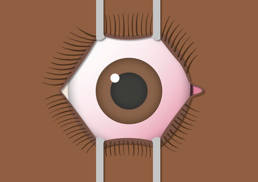 Eye surgery, illustration