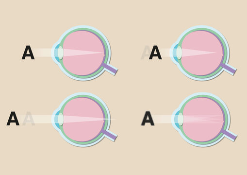Vision disorders, illustration
