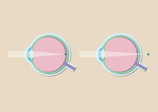 Normal vision and far-sightedness, illustration