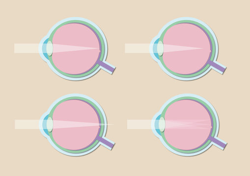 Vision disorders, illustration