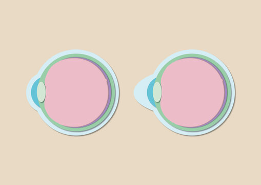 Keratoconus, illustration