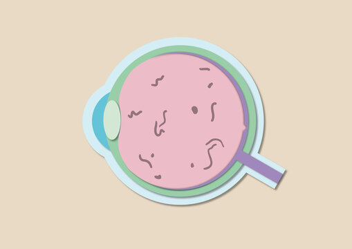 Retinopathy, illustration