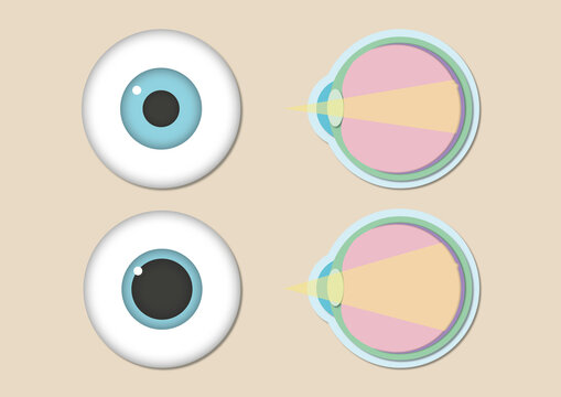 Undilated pupil and dilated pupil, illustration