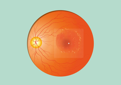 Amsler grid, conceptual illustration