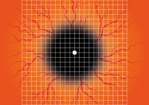 Amsler grid, conceptual illustration