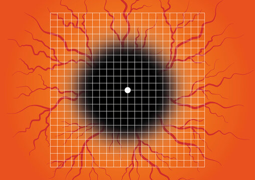 Amsler grid, conceptual illustration