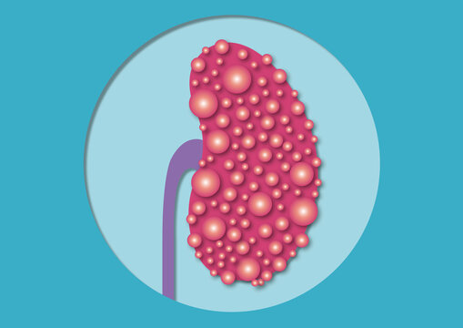 Polycystic kidney disease, conceptual illustration