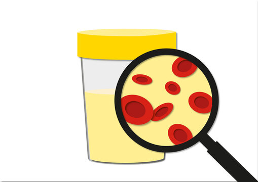 Blood in urine, conceptual illustration