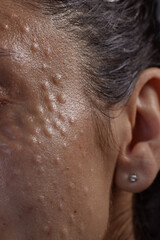 Injectable cosmetology. Facial biorevitalization procedure using a hyaluronic acid-based product. Papules on female face after biorevitalization. close-up