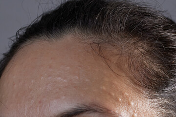 Injectable cosmetology. Facial biorevitalization procedure using a hyaluronic acid-based product. Papules on female face after biorevitalization. close-up