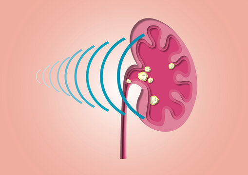 Shockwave therapy for kidney stones, conceptual illustration