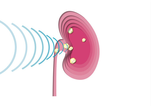 Shockwave therapy for kidney stones, conceptual illustration