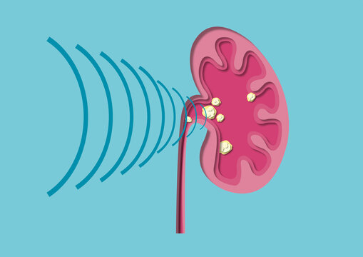 Shockwave therapy for kidney stones, conceptual illustration