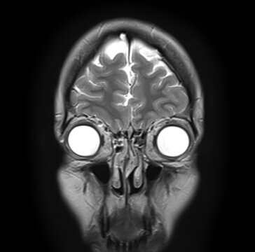 Normal brain MRI, coronal T2-weighted image showing frontal lobes, cerebral cortex, interhemispheric fissure, orbits, globes, ethmoid sinuses and nasal cavity.