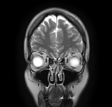 Normal brain MRI, coronal T2-weighted image showing frontal lobes, cerebral cortex, interhemispheric fissure, orbits, globes, ethmoid air cells, maxillary sinuses and nasal cavity.