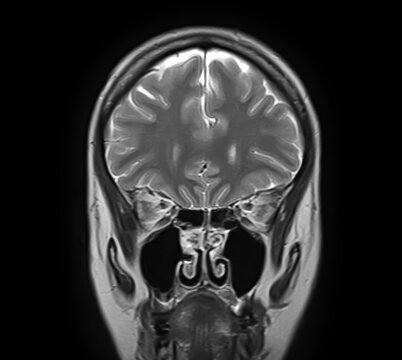 Normal brain MRI, coronal T2-weighted image showing frontal lobes, cerebral cortex, interhemispheric fissure, ethmoid air cells, maxillary sinuses, nasal cavity and turbinates.