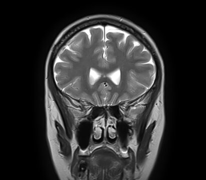 Normal brain MRI, coronal T2-weighted image showing cerebral hemispheres, cortex, lateral ventricles, ethmoid air cells, maxillary sinuses, nasal cavity and turbinates.