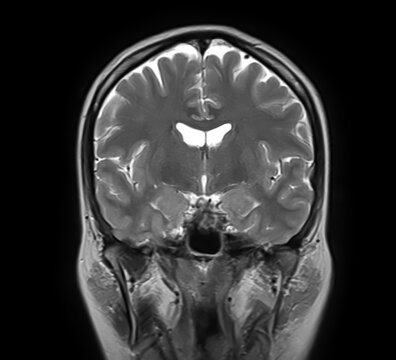 Normal brain MRI, coronal T2-weighted image showing cerebral hemispheres, cortex, lateral ventricles, basal ganglia, thalami, temporal lobes and sphenoid sinus.