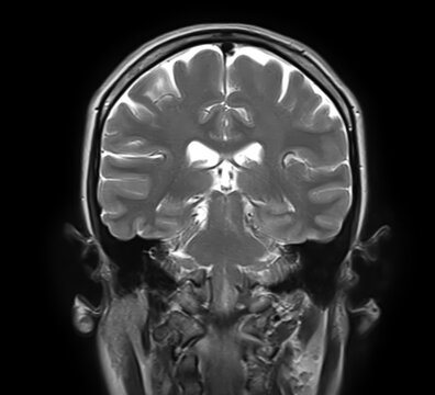 Normal brain MRI, coronal T2-weighted image showing cerebral hemispheres, cortex, lateral ventricles, mesial temporal lobes, hippocampi, brainstem and cerebellum.