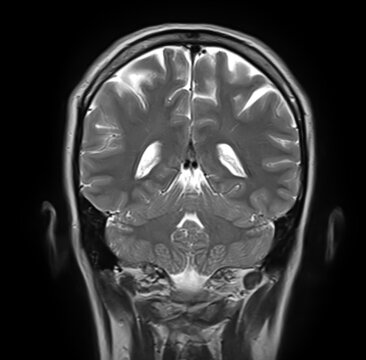 Normal brain MRI, coronal T2-weighted image showing cerebral hemispheres, lateral ventricles, cerebellum, cerebellar hemispheres, vermis and brainstem.