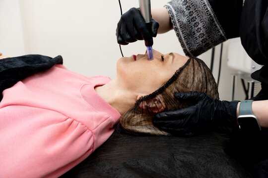  Peeling, women's health care, skin regeneration, microneedling dermapen, dermastamp. Cosmetologist-conducts the procedure of fractional microneedling clinic for the face. Facial rejuvenation