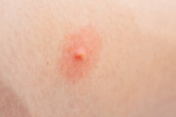 Fototapeta premium An inflamed pimple on the skin with redness around