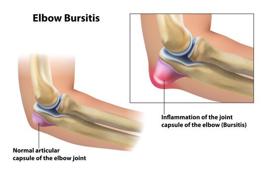 Bursitis elbow. Isolated vector illustration