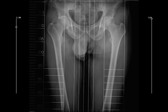 full length standing scanogram of the bilateral lower limbs, captured from the pelvis to the ankle with integrated rulers to assist in orthopedic analysis for limb length measurement and alignment