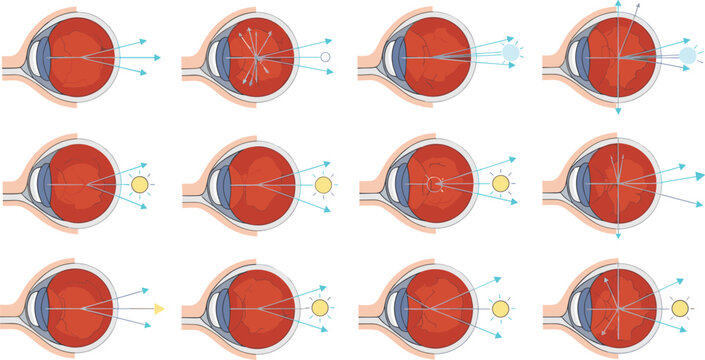Human Eye Refraction and Vision Conditions Set Showing Light Focus, Near and Far Sightedness, and Retinal Image Formation