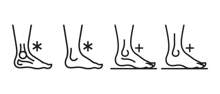 Human Foot Arch Types Line Art Illustration. Normal, High (Cavus), and Flat Feet (Pes Planus) Anatomy.