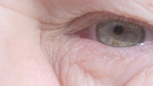 female eye mature woman, close-up wrinkles, under eye bags, swelling on lower eyelid, allergies, kidney disease, medical conditions