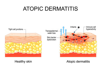 Atopic dermatitis. Atopic eczema.