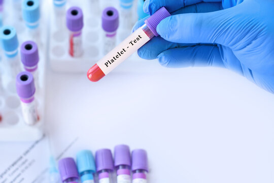 Doctor holding blood sample tube with PLT test measuring platelet count to evaluate blood clotting function, bleeding risk, thrombosis and overall hematology health 