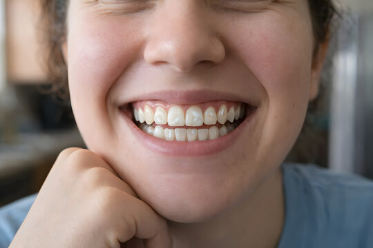 Close Up of White Spot Lesions on Front Teeth and Early Enamel Demineralization