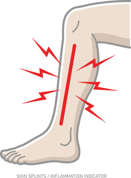 Shin splints inflammation indicator, leg pain, muscle strain graphic illustration