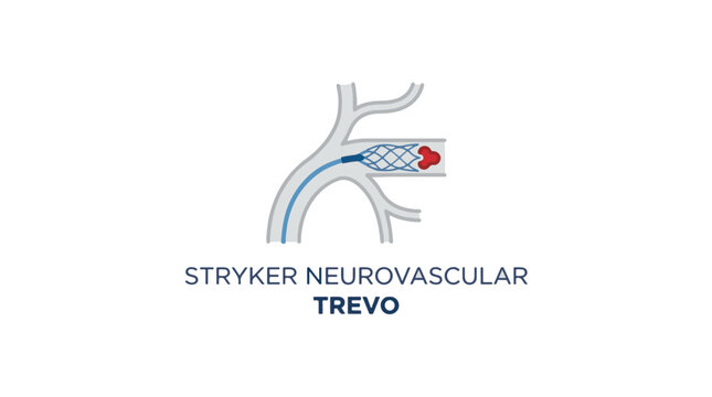 Illustration of the Stryker Trevo retriever device deployed in a blood vessel to remove a blood clot.