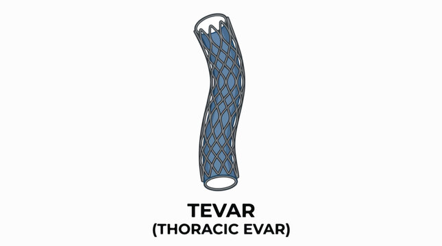 An illustration of a TEVAR (Thoracic EVAR) device, a stent graft used to treat aortic aneurysms in the chest.