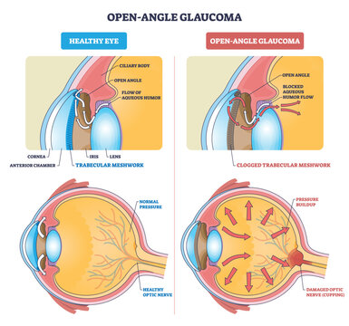 Open-angle glaucoma overview contrasts healthy vs blocked outflow, trabecular meshwork, aqueous humor flow, and optic nerve show pressure buildup concept. Outline diagram