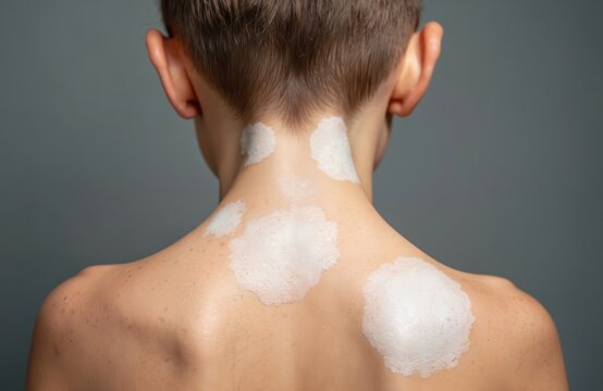 Child with vitiligo skin condition shows depigmented patches on neck and shoulders. Healthy skin with freckles visible underneath white foam.