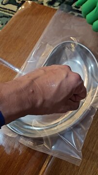 A high-angle close-up shot of a patient's arm during a blood donation or transfusion process, showing the needle insertion and dark red blood flowing into a sterile kidney dish on a wooden table.