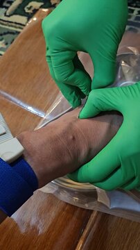 A high-angle close-up shot of a patient's arm during a blood donation or transfusion process, showing the needle insertion and dark red blood flowing into a sterile kidney dish on a wooden table.