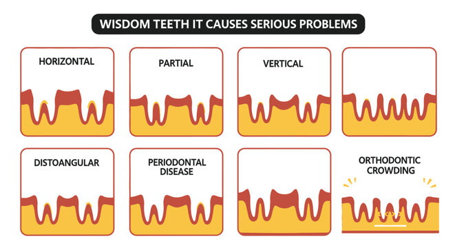 An infographic illustrating different types of wisdom teeth impaction and resulting dental health issues