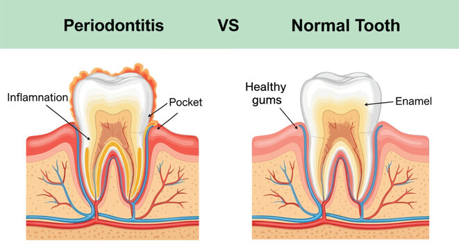 Detailed anatomical comparison showing periodontitis disease progression versus a normal healthy tooth structure