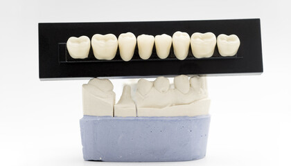 Dental crown samples above tooth preparation model