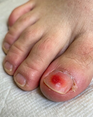 Naklejka premium Infected toe with redness and swelling close up