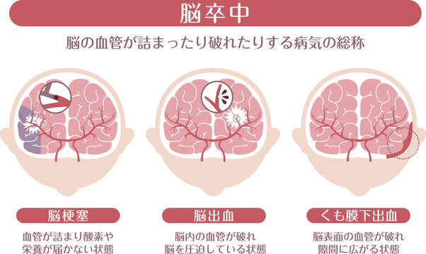 Stroke types medical infographic brain infarction cerebral hemorrhage subarachnoid hemorrhage explanation